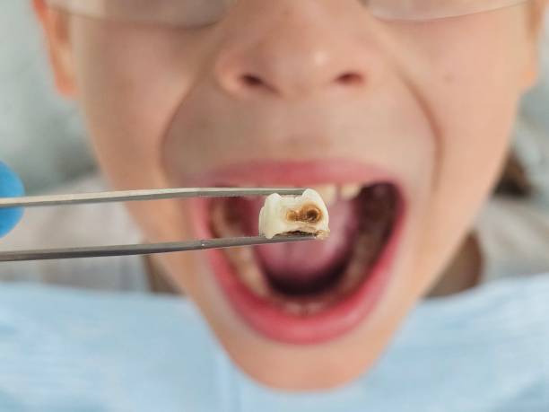 Best Emergency Tooth Extraction in Pittston, PA